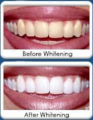 Dental Whitening at Kelly Jorn Cook, DDS and Orthodontics - Chandler, AZ