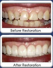 Full mouth reconstruction, restorations with dental crowns, bridgework, dental veneers