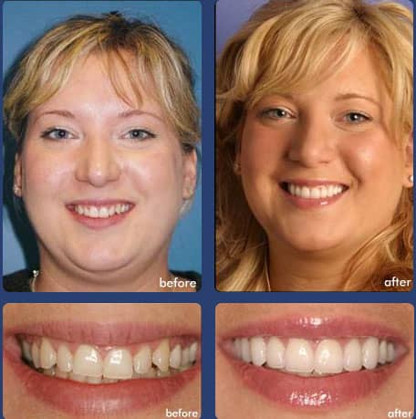 Case 1 - Dental Veneers Dental - Smile Makeover in Chandler, AZ