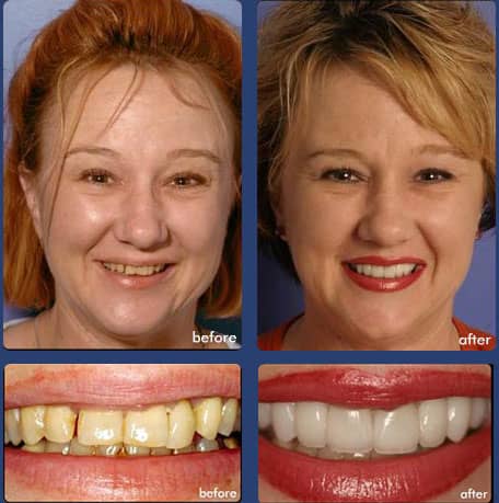 Case 10 - Dental Veneers & Dental Crowns - Dental Case of Smile Makeover in Chandler, AZ