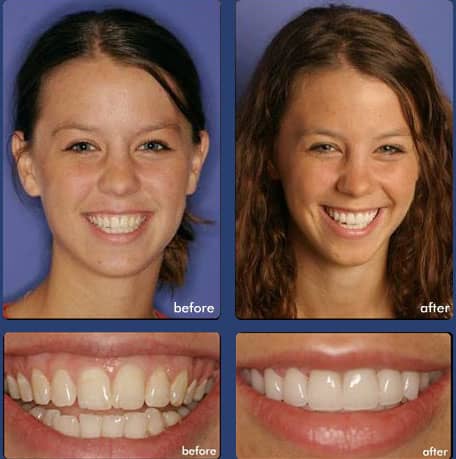 Case 11 - Dental Veneers - Dental Case of Smile Makeover in Chandler, AZ