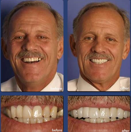 Case 12 - Dental Veneers - Dental Case of Smile Makeover in Chandler, AZ
