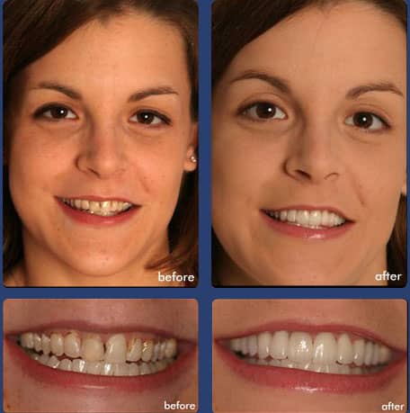 Case 13 Dental Veneers - Dental Case of Smile Makeover in Chandler, AZ
