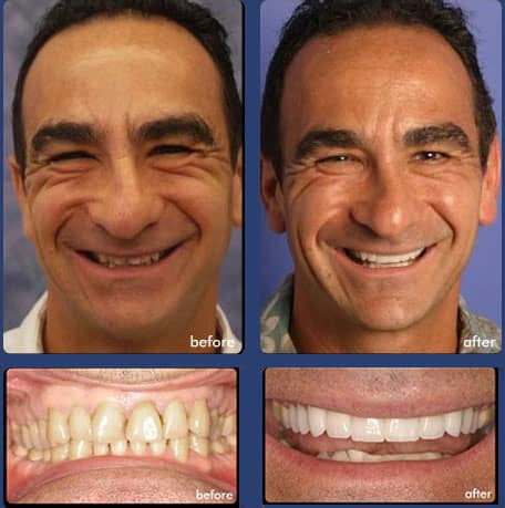 Case 14 - Full Mouth Restoration - Dental Case of Smile Makeover in Chandler, AZ