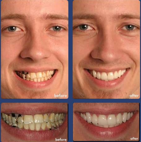 Case 2 - Full Mouth Restoration - Dental Case of Smile Makeover in Chandler, AZ