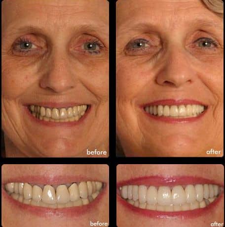 Case 3 - Dental Veneers - Dental Case of Smile Makeover in Chandler, AZ