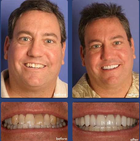 Case 4 - Dental Veneers - Dental Case of Smile Makeover in Chandler, AZ