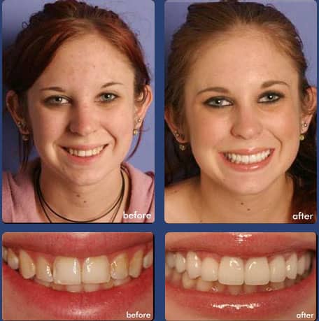 Case 5 - Dental Veneers - Dental Case of Smile Makeover in Chandler, AZ