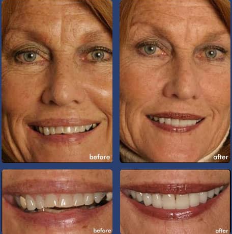 Case 6 - Dental Veneers - Dental Case of Smile Makeover in Chandler, AZ