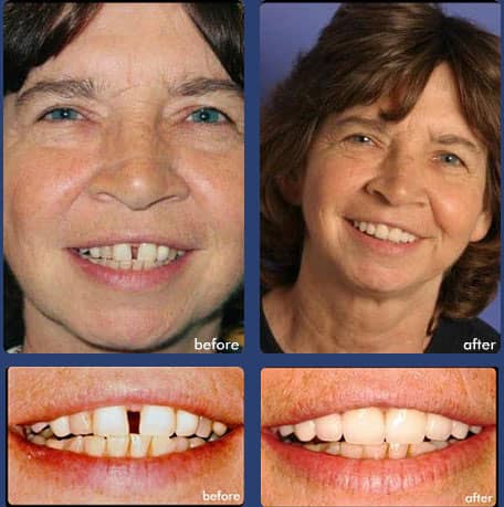 Case 7 - Invisalign - Dental Case of Smile Makeover in Chandler, AZ
