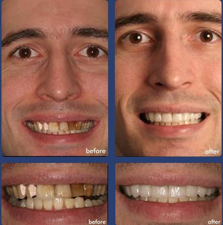 Case 8 - Full Mouth Restoration - Dental Case of Smile Makeover in Chandler, AZ