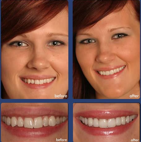 Case 9 - Dental Veneers - Dental Case of Smile Makeover in Chandler, AZ