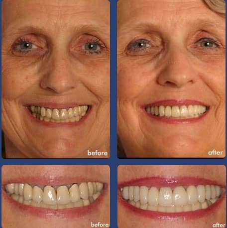  - Dental Case of Smile Makeover in Chandler, AZ