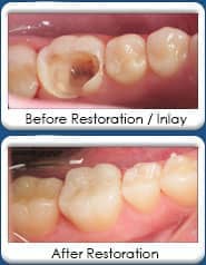 inlay and onlay dental restorations