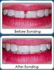 Dental bonding and veneering - before and after
