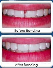 Dental bonding and veneering - before and after