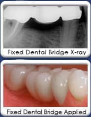 Chandler Dentist - Dental Bridge Single Tooth