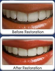 Cosmetic Dental Recontouring - before and after