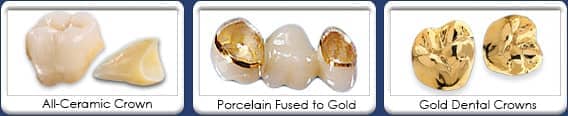 Types of Dental Crown Restorations