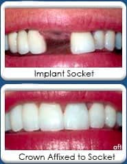 A diagram of dental implants in Chandler, AZ