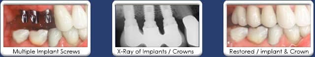multiple dental implant views Chandler, AZ