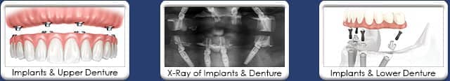 Implant retained denture - illustration, X-ray, and dental appliance Chandler, AZ