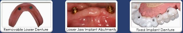 Implant retained denture - removable & fixed dentures