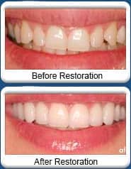 Kelly Jorn Cook, DDS - Chandler - Porcelain Dental Veneers