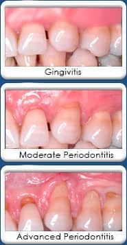 Chandler Dentist - periodontal disease stages