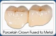 Porcelain Dental Crowns Fused to Metal restorations - Chandler Dentist, Kelly Jorn Cook, DDS