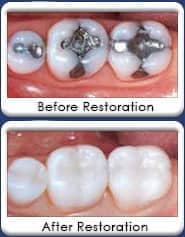 tooth colored, white dental fillings