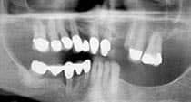Chandler Dentist - Dental X-ray