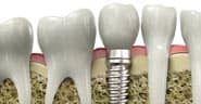 A diagram of dental implants in Chandler, AZ