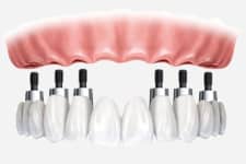 Chandler Dentist - Dentistry Implant Dentisty