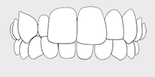 Invisalign correctable - cross bite