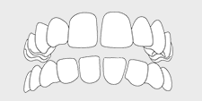 Invisalign correctable - spacing