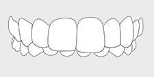 Invisalign correctable - overbite