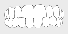 Invisalign correctable - underbite