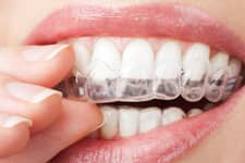 Chandler Dentist - Cosmetic Dentistry - Invisalign™
